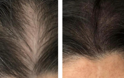Tricopigmentazione e alopecia